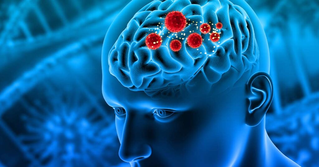 Como os avanços na radioterapia melhoram o prognóstico dos tumores cerebrais