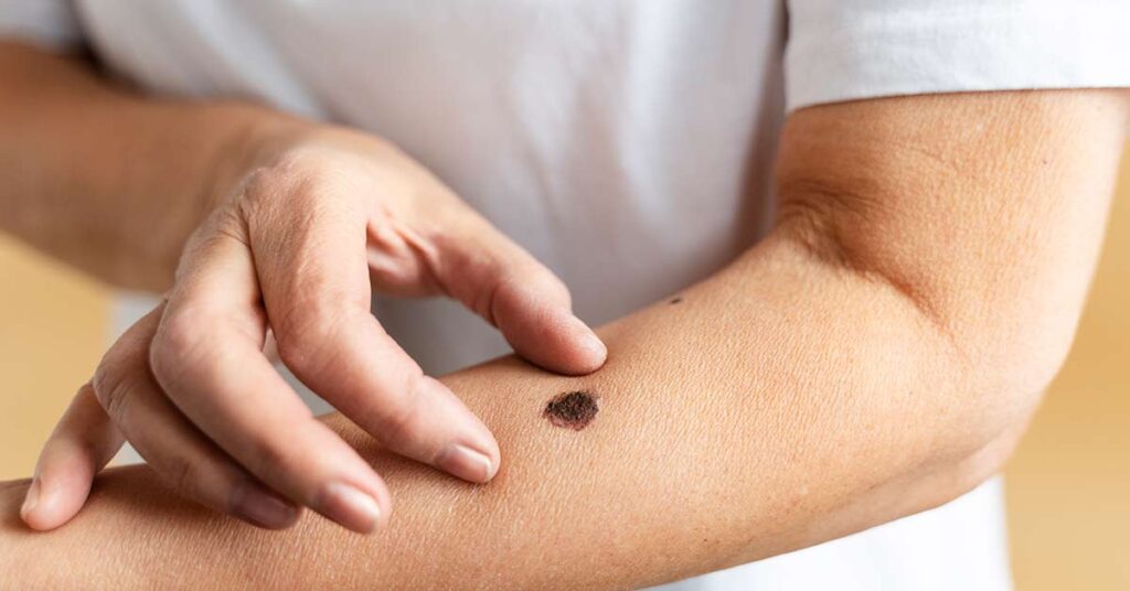 O que os especialistas dizem sobre a eficácia da radioterapia para câncer de pele