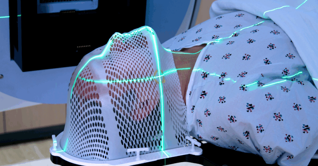 O que os Especialistas Dizem Sobre a Eficacia da Radioterapia em Gliomas