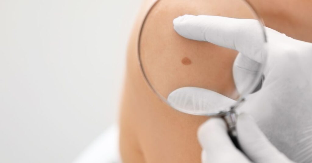 Em quais casos a braquiterapia é preferida no câncer de pele