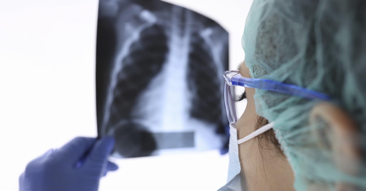 Como funciona a radioterapia no tratamento do câncer de pulmão de pequenas células