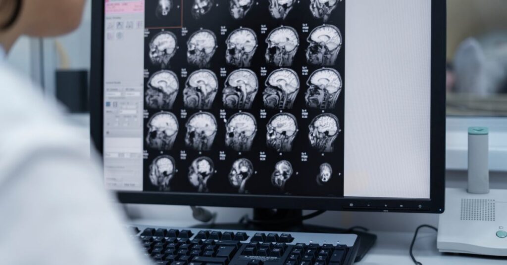 Meningioma e radioterapia: quando o tratamento é indicado